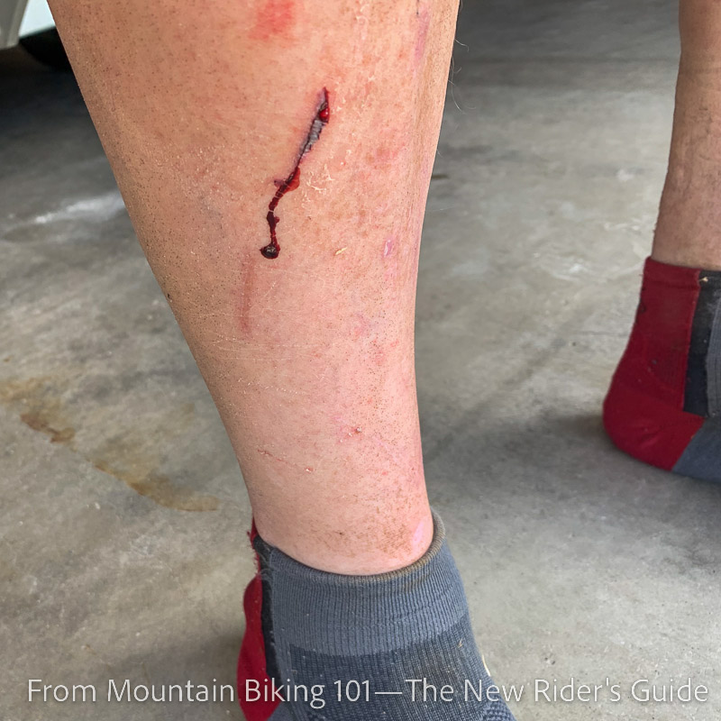 Shin wounds from flat pedals